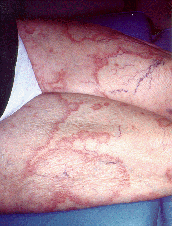 Granuloma Annulare Causes a Harmless Rash to Develop On the Skin